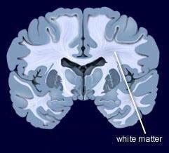 minimal supratentorial white matter disease | Chicago Criminal and ...