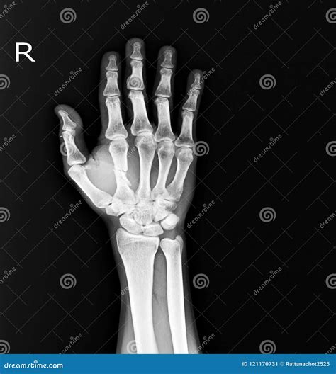 X-ray Hand AP,OBLIQUE:fracture Mid Shaft Rt.2nd. Metacapal Bone. Stock ...