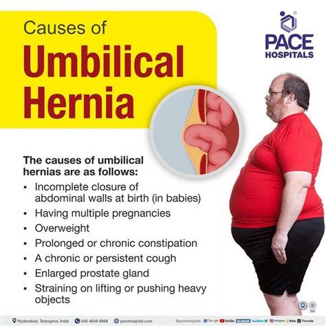 Umbilical Hernia Symptoms, Causes, Complications And, 45% OFF