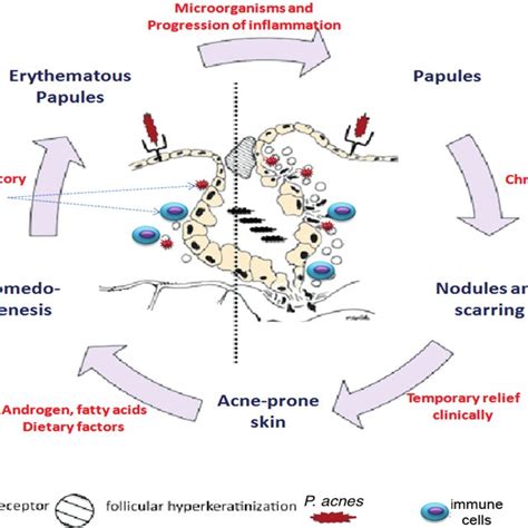 Inflammatory mechanisms involved in different stages of acne vulgaris ...