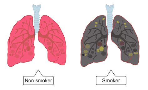 Cilia In Lungs Smoking