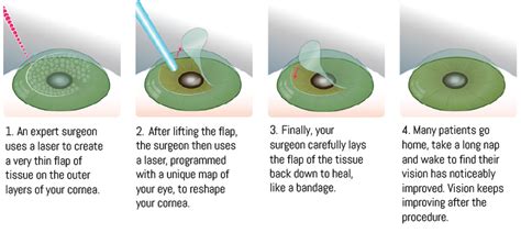 LASIK – EyeCare Associates of South Tulsa