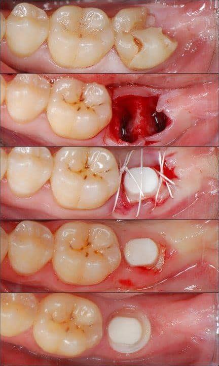 How Long is Recovery After Dental Implant Surgery?