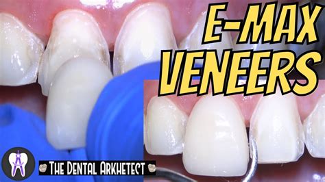 EMAX Porcelain Veneer! HOW Do they DO it? #C41 #4k - YouTube