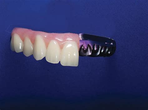 The Hybrid Denture in a Class of its Own - Burbank Dental Lab