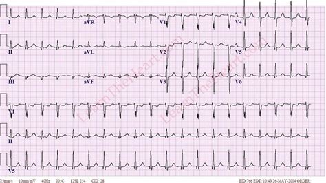 Junctional Tachycardia ECG | Learn the Heart