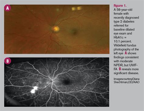 Aflibercept PANORAMA study results in