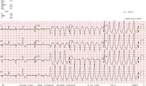 Ventricular Tachycardia Vs Supraventricular Tachycardia