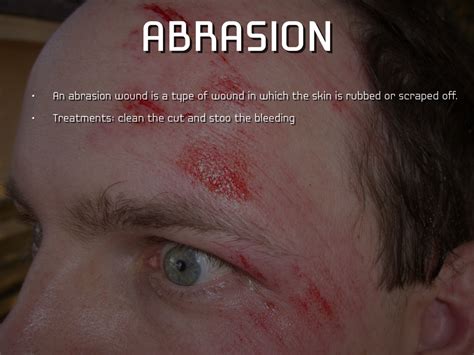 Abrasion Wound Diagram