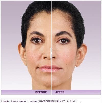 How Much Does Juvederm Dermal Filler Cost? - The Aesthetic Center for Plastic Surgery (ACPS)