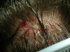 8 Sores on Scalp ideas | sores on scalp, scalps, soreness