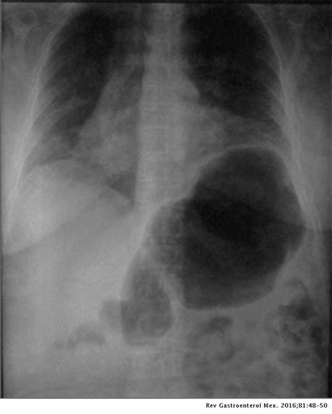 Acute gastric dilation after trauma | Revista de Gastroenterología de México