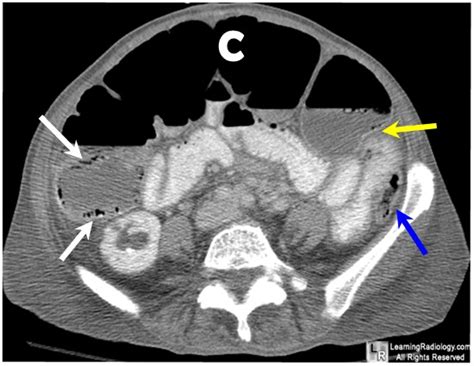 LearningRadiology - Colon, Cut-off, Sign, radiology, plain, film, ct ...