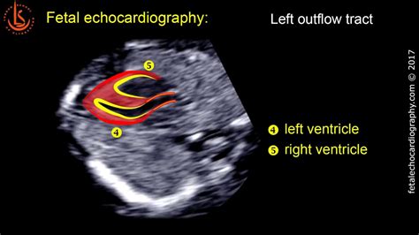 Fetal echocardiography at 11-13 weeks: Technique of Early Heart Scan - YouTube