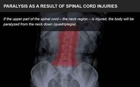 Paralysis - Quadriplegic, Paraplegic Spinal Cord Injury Victims