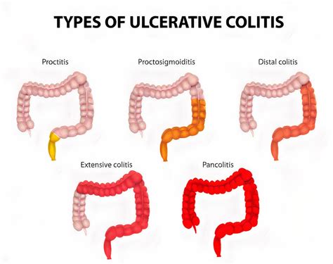 Ulcerative Colitis (UC): Causes, Symptoms, Types, Diagnosis & Treatment - Page 5 of 18 - Left ...