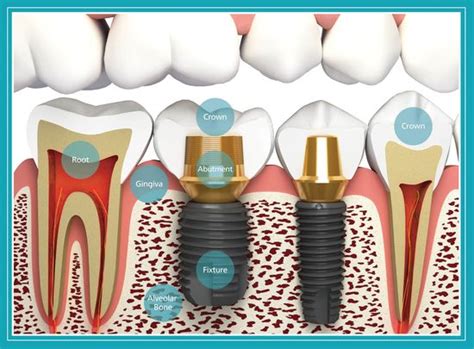 G4 BY Golpa - Golpa Dental Implant Center (1dentalimplants) - Profile ...