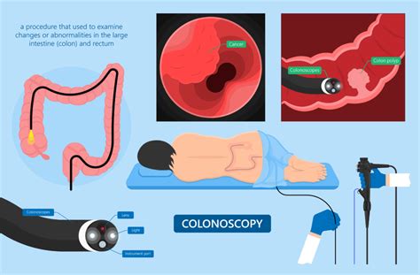 Endoscopy: Why you should STOP avoiding scheduling your Colorectal (Colon) Cancer Screening ...