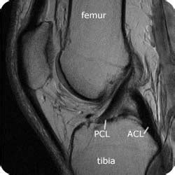 Mri Knee Acl Tear