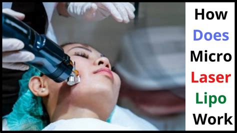 Micro Laser Liposuction Cost - And other things you need to KNOW!