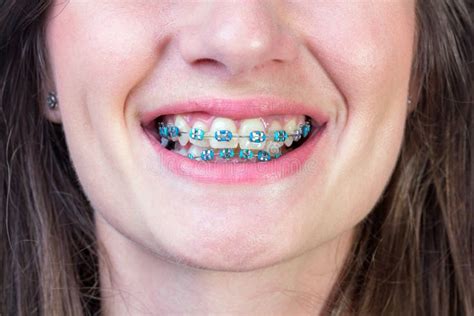 Dental braces stock photo. Image of blue, posing, closeup - 46845388