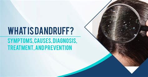 Dandruff: Symptoms, Causes, Diagnosis, Treatment, and Prevention