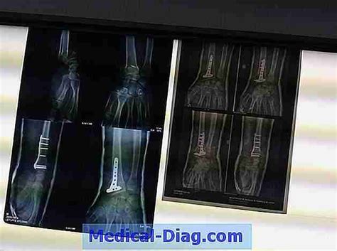 Fracture De Colles: Traitement Et Récupération (Medical-Diag.com 2024)