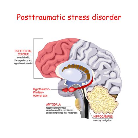 Hypnotherapy for PTSD: Why Consider It? * Hemisphere Hypnotherapy