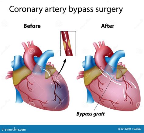 Heart Bypass Surgery Stock Image - Image: 22132891