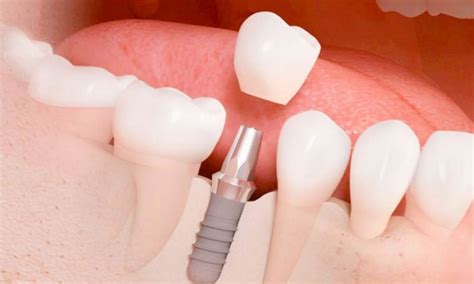 Implantes Dentales en CDMX | Clínica Dental | DR. MOLINA