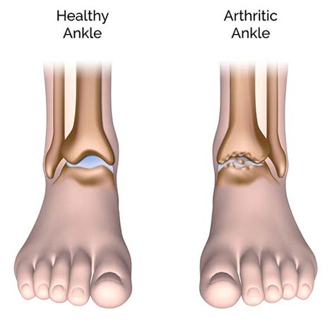 Ankle Arthritis and Degenerative Joint Disease, Patient Education