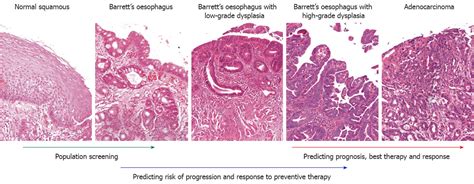 Barretts Esophagus Histology