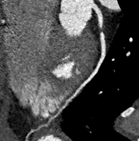 020419-Fig-2-SHEN-CT-CORONARY-ANGIOGRAM - Medical Forum