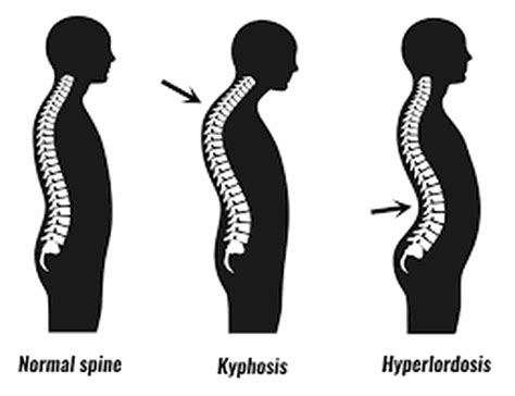 Treatment of kyphosis - MEDizzy