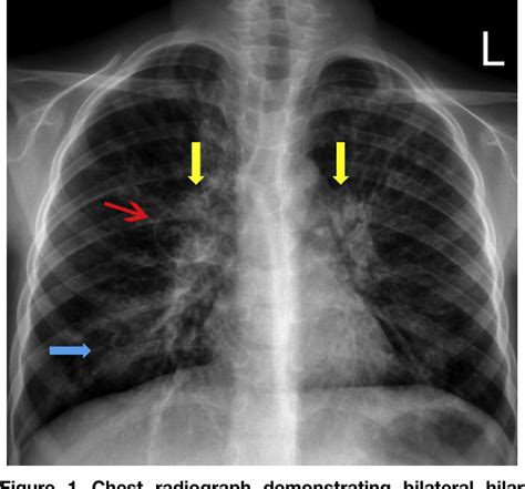 Asthma Chest X Ray