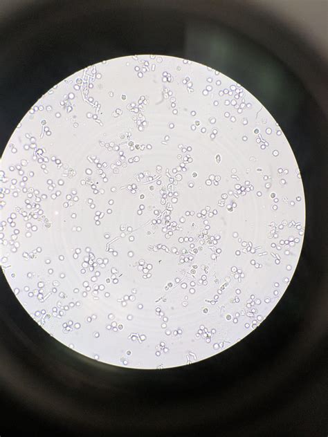 Hyphae in routine urine microscopic examination : r/medlabprofessionals