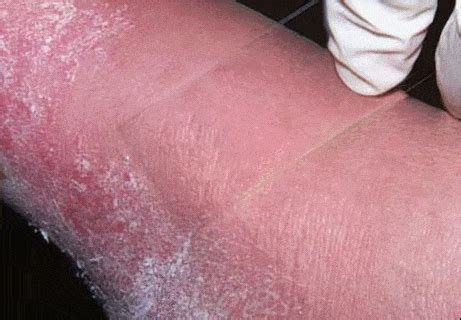 Blanching Skin – Causes, Symptoms, Diagnosis and Treatment