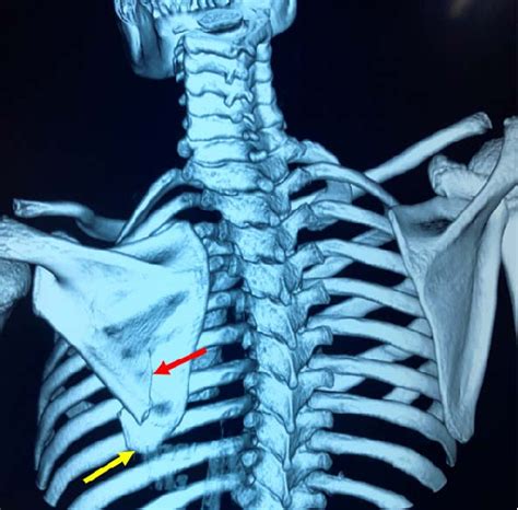 3D reconstruction of the posterior chest wall by CT. Note the presence ...