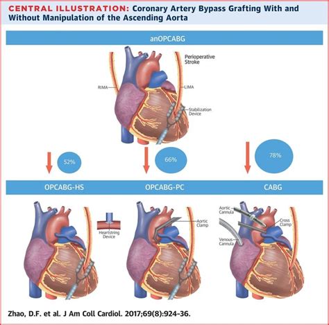 78% Stroke Reduction with Newer No-Touch Beating Heart Bypass Surgery, According to Landmark Study