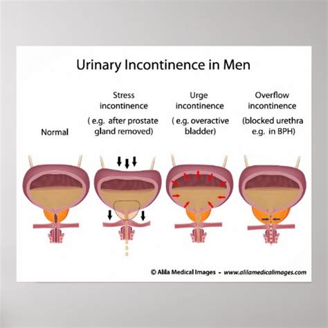 Male urinary incontinence print | Zazzle