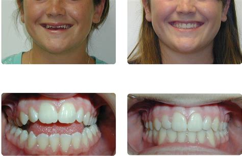 Orthodontic Before and After Photos | Brodsky Orthodontics