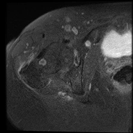 Synovial herniation pit - growing | Image | Radiopaedia.org