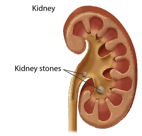 Kidney Stones Symptoms, Risk Factors, and Diagnosis | Saint John’s ...