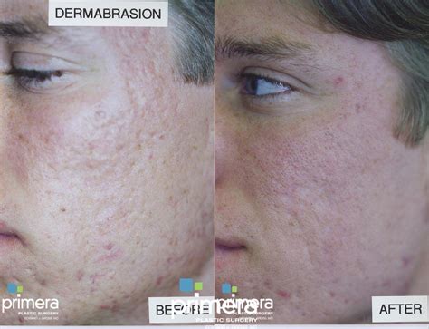 Dermabrasion Before and After Photo Gallery | Orlando, Florida ...