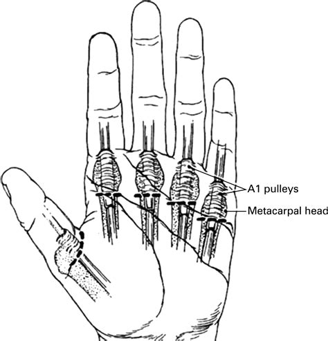 Single injection digital anaesthesia: an easy technique for paediatric finger injuries ...