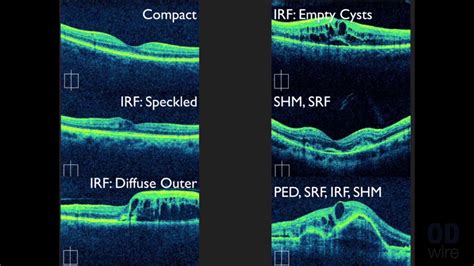 Macular OCT Interpretation: A Practical Discussion with Dr. David E ...