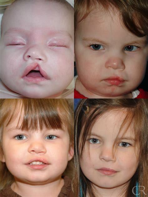 Cleft Lip & Palate - Kentucky Center for Cosmetic & Reconstructive Surgery