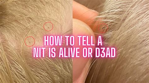 How can you tell a Nit is D3ad or Alive l Lice Removal / Nit Removal ...