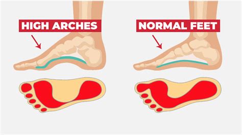 29 Quick Solutions That Every Runner With Foot Pain Need to Know