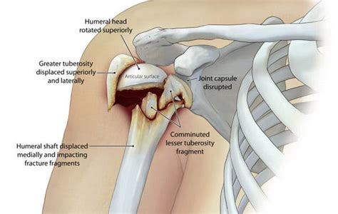 Understanding Comminuted Fractures in Children: Causes, Symptoms, and Treatment – Vincent Wang ...